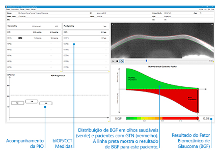Este software revolucionário permite uma fácil triagem de glaucoma baseada em resposta biomecânica.