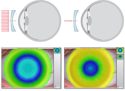 gás-permeabilidade de oxigênio para lentes de contato gelatinosas com potência esférica de -3,0 D (esquerda) / - 6,0 D (direita)